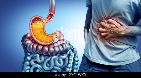 Sodbrennen und saurer Reflux oder gastroösophageale Krankheit oder GERD als offener Schließmuskel mit einem entzündeten Ösophagus als medizinisches Symbol für Aufstoßen Stockfoto