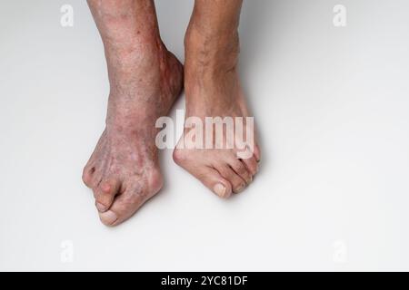 Die Überkopfaufnahme erfasst die Füße einer älteren Frau und zeigt sichtbare Effekte von Bunion und Hallux valgus auf weißem Hintergrund, Deformität des MTP-Gelenks, das den großen Zeh mit dem Fuß verbindet Stockfoto