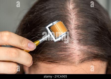 Nahaufnahme einer jungen Frau mit Mikronadelderma-Roller am Kopf zur Stimulierung des Haarwuchses zu Hause. Behandlung der gesunden Kopfhaut. Stockfoto