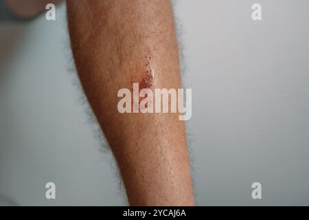 Kratzspuren auf der Hautoberfläche durch scharfe Fingernägel, Kratzer an Juckreiz, Makroansicht von Nahaufnahme. Narbe am Oberschenkel eines Mannes, verursacht durch Kratzen am Juckreiz Stockfoto