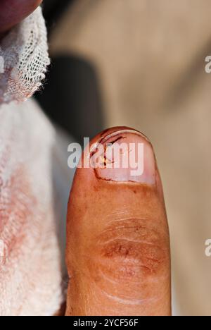 Personennagel am Handfinger nach Unfall mit der Motorsäge Stockfoto