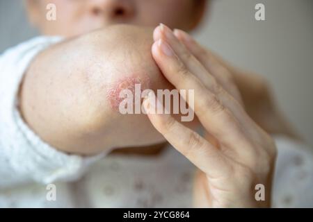 Nahaufnahme einer Person, die einen roten, trockenen Hautfleck am Ellenbogen berührt und Anzeichen von Psoriasis oder Ekzem zeigt Stockfoto