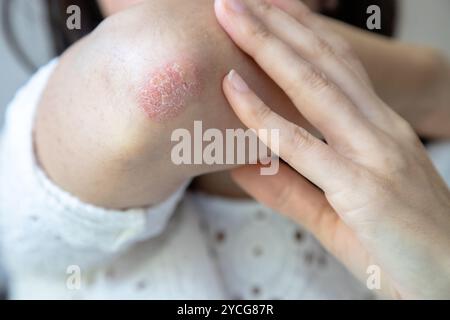 Nahaufnahme einer Person, die einen roten, trockenen Hautfleck am Ellenbogen berührt und Anzeichen von Psoriasis oder Ekzem zeigt Stockfoto