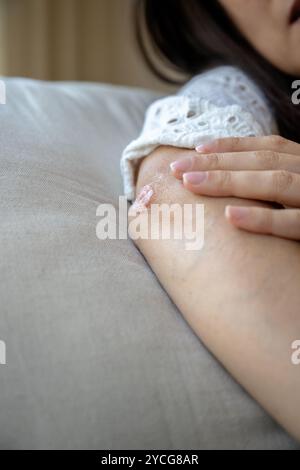 Nahaufnahme einer Person, die einen roten, trockenen Hautfleck am Ellenbogen berührt und Anzeichen von Psoriasis oder Ekzem zeigt Stockfoto