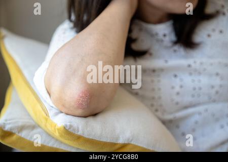 Nahaufnahme einer Person mit einem roten, trockenen Hautfleck am Ellenbogen, das Anzeichen einer Psoriasis oder eines Ekzems zeigt Stockfoto