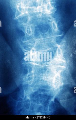 Die lumbale Osteoporose (Kompressionskrankheit und Frakturen der Lendenwirbel). Röntgenaufnahme der Lendenwirbel von vorne gesehen. Stockfoto
