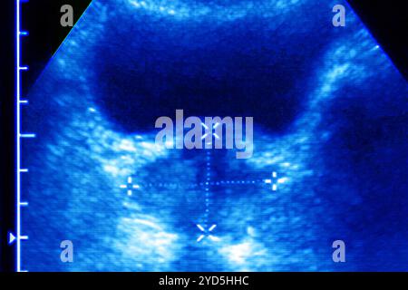 Prostata- und Blasenkontrolluntersuchung mit Messungen der Prostata (normale Prostata und Blase). Frontale Sonographie der Prostata. Stockfoto