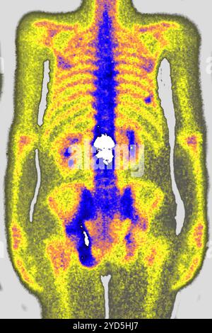 Die lumbale Osteoporose (Kompressionskrankheit und Frakturen der Lendenwirbel). Röntgenaufnahme der Lendenwirbel von vorne gesehen. Stockfoto