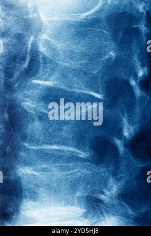 Die lumbale Osteoporose (Kompressionskrankheit und Frakturen der Lendenwirbel). Röntgenaufnahme der Lendenwirbel von vorne gesehen. Stockfoto