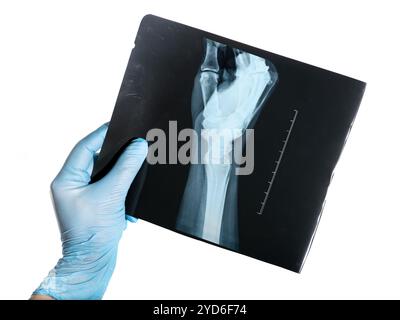 Hand in medizinischen blauen Handschuh hält Röntgenaufnahme der Seite der Hand einer Frau ungewöhnliche traumatische Handgelenkverletzung Stockfoto