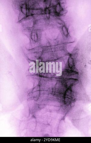 Die lumbale Osteoporose verursacht Kompressionen und Frakturen der Lendenwirbel. Röntgenaufnahme der Lendenwirbel von vorne gesehen. Lumbale Osteoporose. 016836 032 Stockfoto