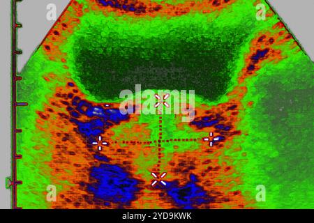 Prostata- und Blasenkontrolluntersuchung mit Messungen der Prostata-NormalProstata und -Blase. Frontale Sonographie der Prostata. Prostata-Ultraschall 016836 045 Stockfoto