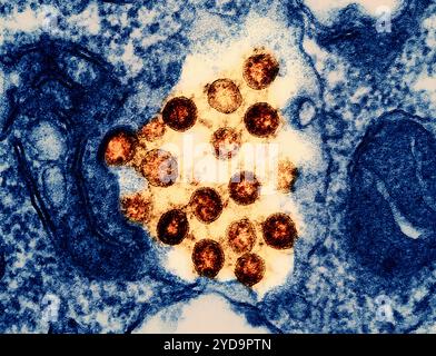 Transmissionselektronenmikrogramm rot gefärbter SARS-CoV-2-Viruspartikel, isoliert aus einer Patientenprobe. Neuartiges Coronavirus SARS-CoV-2 Omicron 016867 104 Stockfoto