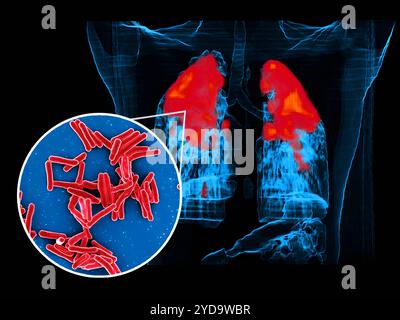 Rasterelektronenmikroskop von Mycobacterium tuberculosis-Bakterien, die TB-kreisförmiges Vordergrundbild verursachen Bakterien sind rot gefärbt und ein PET/CT-Scan zeigt TB-Infektion rot in einem Lungen-Hintergrundbild des Patienten. Mycobacterium tuberculosis-Bakterien, die Ursache der TB 016867 402 Stockfoto