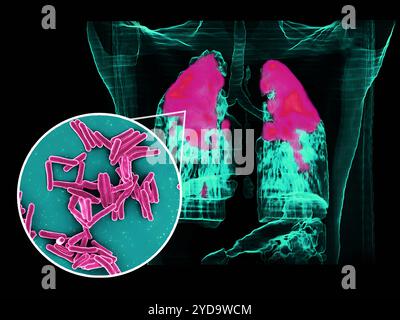 Rasterelektronenmikroskop von Mycobacterium tuberculosis-Bakterien, die TB-kreisförmiges Vordergrundbild verursachen Bakterien sind rosa gefärbt und ein PET/CT-Scan zeigt TB-Infektion rosa in einem Lungen-Hintergrundbild des Patienten. Mycobacterium tuberculosis-Bakterien, die Ursache der TB 016867 403 Stockfoto