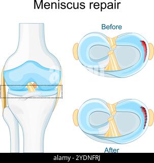 Meniskusverletzung. Nahaufnahme des Kniegelenkes. Meniskusriss vor und nach Operationen. Nahtreparatur. Meniskusheilung. Draufsicht auf ein menschliches Knie. Vektorposition Stock Vektor