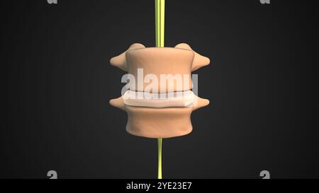 Vertebralrutschen mit Spondylolisthesesesymptomen Stockfoto