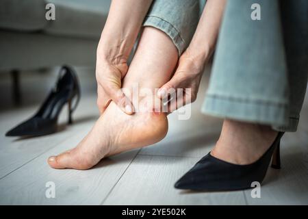 Kallus an der Ferse von engen Schuhen. Die Füße der Frau haben Schmerzen, nachdem sie nach dem Gehen Schuhe mit hohen Absätzen getragen haben. Stockfoto