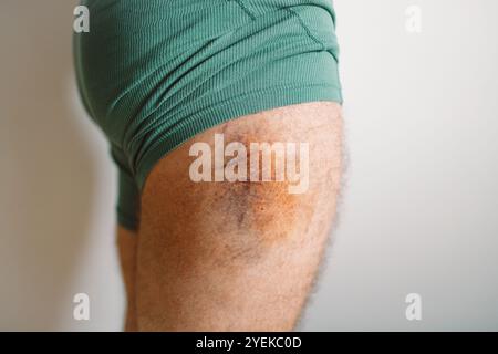 Oberschenkelverletzung durch Kollision, Aufprall oder Stürze, Blutergüsse am Bein. Sehr große blaue Flecken an der inneren Oberschenkeloberfläche des Beines des Mannes. Unfall beim Spielen Stockfoto