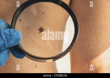 Mole-Dermoskopie, Melanom-Prophylaxe. Dermatologe untersucht das Muttermal des Patienten mit Lupe in der Klinik. Prüfung gutartiger Muttermale. Hautbild nicht Stockfoto