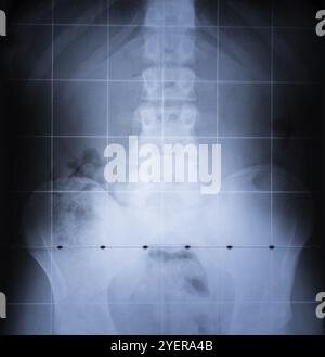 X-Ray Bild der Wirbelsäule und des Beckens des menschlichen Körpers Stockfoto