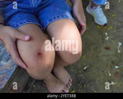 Ein junges Mädchen hat sich beim Spielen auf einem Spielplatz das Knie verletzt. Das verletzte Knie des Kindes. Stockfoto