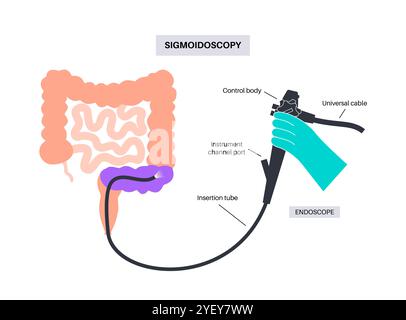 Konzeptionelle Darstellung eines Sigmoidoskopieverfahrens. Dies ist ein diagnostischer Test, mit dem der Kolon Sigmoid, der untere Teil des Dickdarms oder der Dickdarm überprüft werden. Das Verfahren kann verwendet werden, um eine Biopsie zu nehmen und Polypen oder Hämorrhoiden zu entfernen. Es ist auch ein Screening-Test für Darmkrebs und Rektumkrebs. Stockfoto