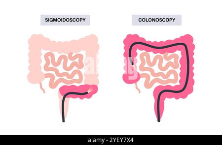 Konzeptionelle Darstellung von Koloskopie- und Sigmoidoskopieverfahren. Bei beiden Verfahren wird nach abnormalen Bereichen im Kolon und Rektum gesucht. Beide verwenden eine dünne flexible Röhre mit Kamera und Licht am Ende, um den Dickdarm zu betrachten. Bei einer Koloskopie wird der gesamte Kolon untersucht, bei einer Sigmoidoskopie wird der Kolon Sigmoid untersucht. Stockfoto