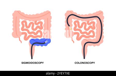Konzeptionelle Darstellung von Koloskopie- und Sigmoidoskopieverfahren. Bei beiden Verfahren wird nach abnormalen Bereichen im Kolon und Rektum gesucht. Beide verwenden eine dünne flexible Röhre mit Kamera und Licht am Ende, um den Dickdarm zu betrachten. Bei einer Koloskopie wird der gesamte Kolon untersucht, bei einer Sigmoidoskopie wird der Kolon Sigmoid untersucht. Stockfoto