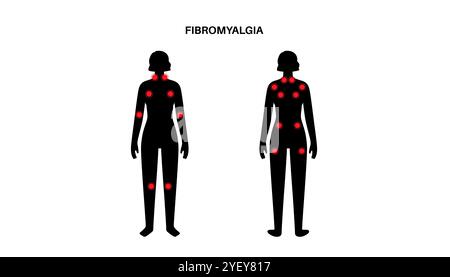 Konzeptuelle Darstellung der Fibromyalgie. Fibromyalgie ist eine chronische Erkrankung, die Schmerzen und Druckempfindlichkeit im ganzen Körper sowie Müdigkeit und Schlafstörungen verursacht. Die genaue Ursache ist unbekannt, wird aber oft durch körperlichen oder psychischen Stress ausgelöst. Stockfoto