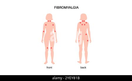 Konzeptuelle Darstellung der Fibromyalgie. Fibromyalgie ist eine chronische Erkrankung, die Schmerzen und Druckempfindlichkeit im ganzen Körper sowie Müdigkeit und Schlafstörungen verursacht. Die genaue Ursache ist unbekannt, wird aber oft durch körperlichen oder psychischen Stress ausgelöst. Stockfoto