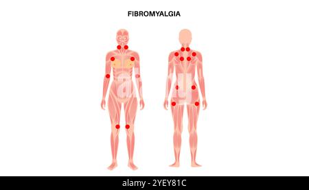 Konzeptuelle Darstellung der Fibromyalgie. Fibromyalgie ist eine chronische Erkrankung, die Schmerzen und Druckempfindlichkeit im ganzen Körper sowie Müdigkeit und Schlafstörungen verursacht. Die genaue Ursache ist unbekannt, wird aber oft durch körperlichen oder psychischen Stress ausgelöst. Stockfoto