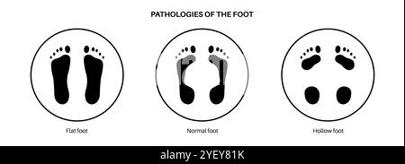 Konzeptuelle Darstellung von Fusskrankheiten einschließlich flacher, normaler und hohler Fussbedingungen. Ein flacher Fuß hat keinen Bogen oder einen sehr niedrigen Bogen, während ein hohler Fuß durch übermäßige Bögen gekennzeichnet ist. Stockfoto