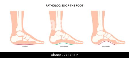 Konzeptuelle Darstellung von Fusskrankheiten einschließlich flacher, normaler und hohler Fussbedingungen. Ein flacher Fuß hat keinen Bogen oder einen sehr niedrigen Bogen, während ein hohler Fuß durch übermäßige Bögen gekennzeichnet ist. Stockfoto