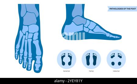 Konzeptuelle Darstellung von Fusskrankheiten einschließlich flacher, normaler und hohler Fussbedingungen. Ein flacher Fuß hat keinen Bogen oder einen sehr niedrigen Bogen, während ein hohler Fuß durch übermäßige Bögen gekennzeichnet ist. Stockfoto