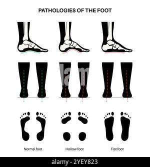 Konzeptuelle Darstellung von Fusskrankheiten einschließlich flacher, normaler und hohler Fussbedingungen. Ein flacher Fuß hat keinen Bogen oder einen sehr niedrigen Bogen, während ein hohler Fuß durch übermäßige Bögen gekennzeichnet ist. Stockfoto