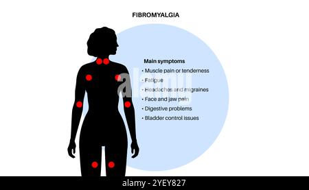 Konzeptuelle Darstellung der Fibromyalgie. Fibromyalgie ist eine chronische Erkrankung, die Schmerzen und Druckempfindlichkeit im ganzen Körper sowie Müdigkeit und Schlafstörungen verursacht. Die genaue Ursache ist unbekannt, wird aber oft durch körperlichen oder psychischen Stress ausgelöst. Stockfoto