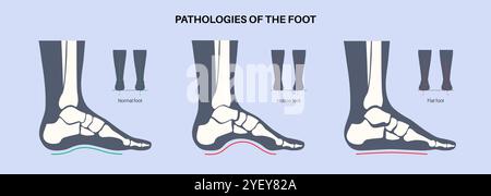 Konzeptuelle Darstellung von Fusskrankheiten einschließlich flacher, normaler und hohler Fussbedingungen. Ein flacher Fuß hat keinen Bogen oder einen sehr niedrigen Bogen, während ein hohler Fuß durch übermäßige Bögen gekennzeichnet ist. Stockfoto