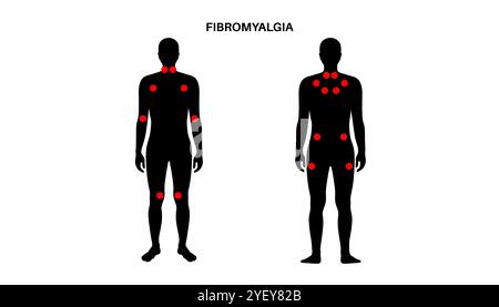 Konzeptuelle Darstellung der Fibromyalgie. Fibromyalgie ist eine chronische Erkrankung, die Schmerzen und Druckempfindlichkeit im ganzen Körper sowie Müdigkeit und Schlafstörungen verursacht. Die genaue Ursache ist unbekannt, wird aber oft durch körperlichen oder psychischen Stress ausgelöst. Stockfoto