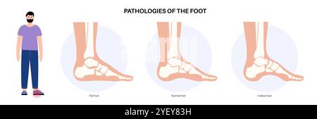 Konzeptuelle Darstellung von Fusskrankheiten einschließlich flacher, normaler und hohler Fussbedingungen. Ein flacher Fuß hat keinen Bogen oder einen sehr niedrigen Bogen, während ein hohler Fuß durch übermäßige Bögen gekennzeichnet ist. Stockfoto