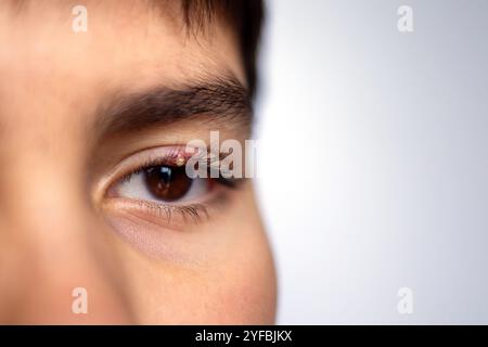 Nahaufnahme eines Jungen-Auges mit kleinem Stich am Oberlid in detaillierter Makroansicht. Geschwollene und irritierte Haut um die Wimpern herum. Gesundheits- und medizinisches Konzept für e Stockfoto