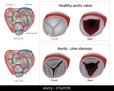 Aortenklappenstenose und gesunde Aortenklappe. Herzklappenerkrankung. Stock Vektor