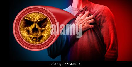 Verstopfung der Koronararterie und Brustschmerzen, die zu einem Herzinfarkt oder einem Myokardinfarkt und Atherosklerose als blockierte und eingeschränkte Arterien führen Stockfoto