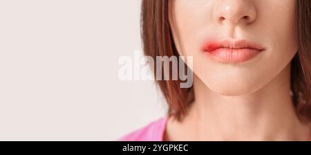 Junge Frau mit kalter Wunde auf der Lippe vor hellem Hintergrund mit Platz für Text, Nahaufnahme Stockfoto