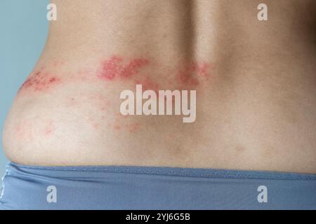 Herpes zoster Gürtelrose-Krankheit an einer Frau Rückenhaut Stockfoto