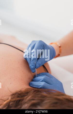 Physiotherapeut mit trockener Nadel auf dem Rücken des Patienten zur Schmerzlinderung Stockfoto