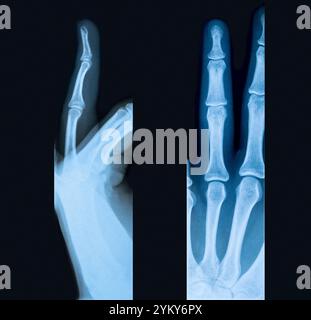 Zwei Röntgenaufnahmen eines gebrochenen Fingers Stockfoto