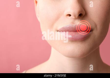 Junge Frau mit kalter Wunde auf der Lippe vor rosa Hintergrund, Nahaufnahme Stockfoto