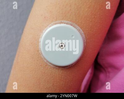 Nahaufnahme des vorliegenden Sensors für das Gerät zur kontinuierlichen Blutzuckerüberwachung – CGM. Insulinabhängig. Diabetes Typ 1 Stockfoto