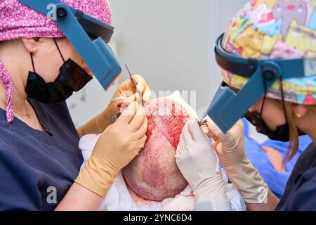 Chirurgen, die ein Haartransplantationsverfahren mit Präzisionswerkzeugen auf der Kopfhaut eines Patienten durchführen Stockfoto